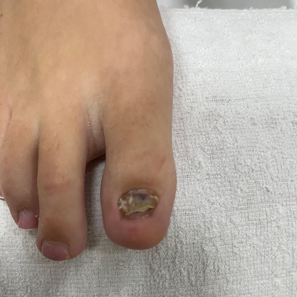 Nagelrekonstruktion vorher.