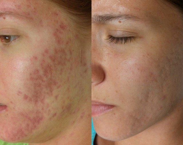 Microneedling-Behandlung im Angelique Beautysalon in Wien-Währing